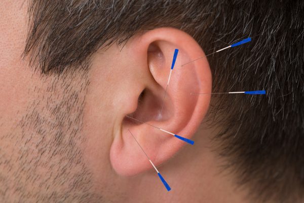Acupuncture – A Potent Anti-Inflammatory Therapy